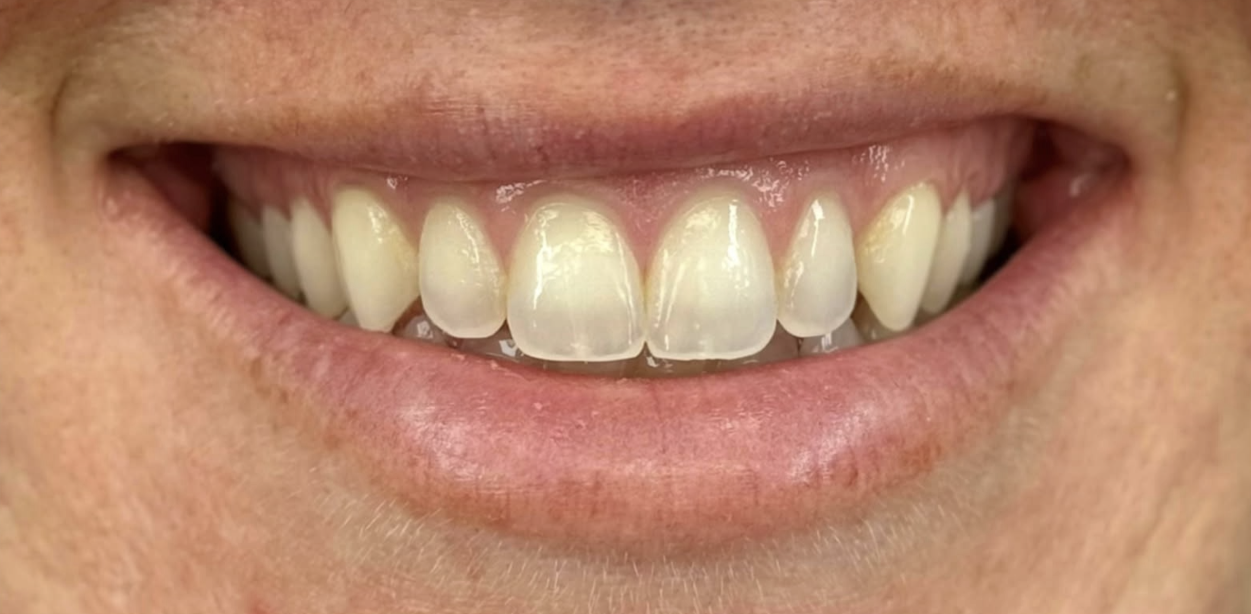 Close-up of a person's smiling mouth showing upper teeth with some visible yellowing or staining.
