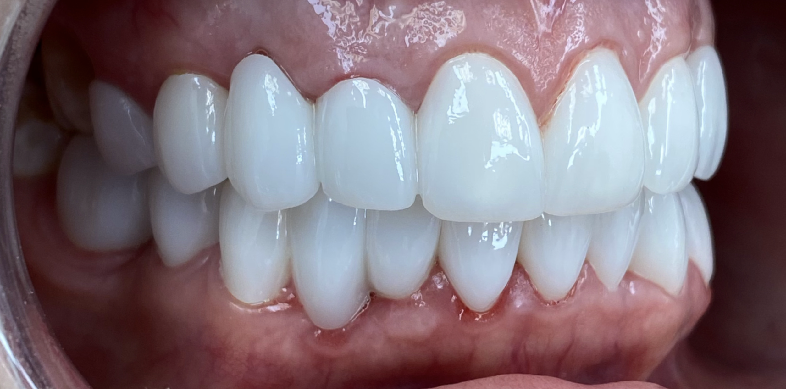 Close-up of a person's teeth, showcasing upper and lower teeth with dental veneers or crowns, appearing clean, bright, and well-aligned.