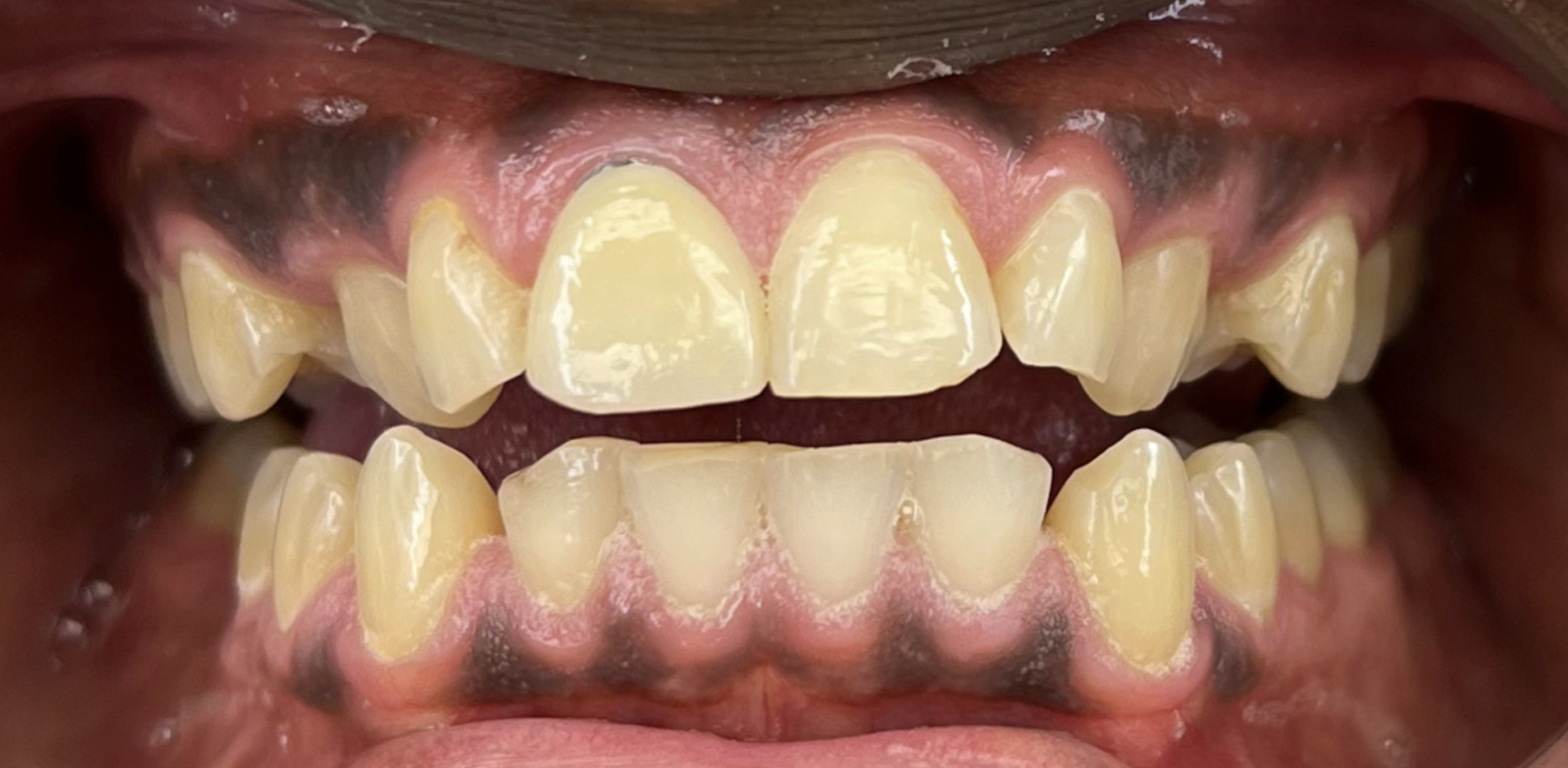 Close-up of a person's open mouth showing uneven, crowded teeth with some discoloration and gum redness.