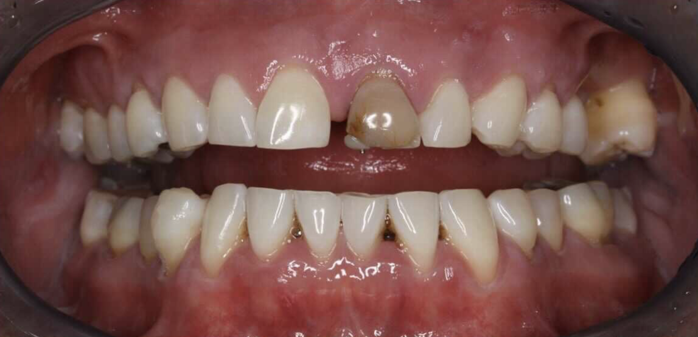 Close-up of teeth with significant discoloration, plaque, and cavities visible, especially on upper front teeth.