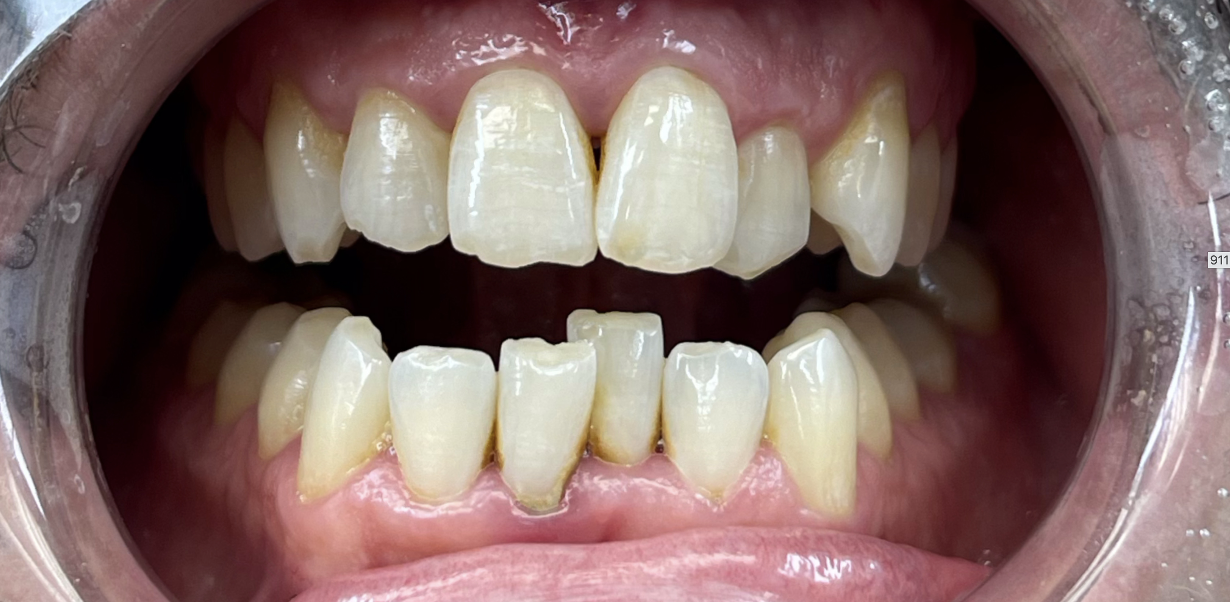 Close-up of a person's mouth showing discolored and chipped teeth, some with visible plaque, and gums that appear slightly inflamed.