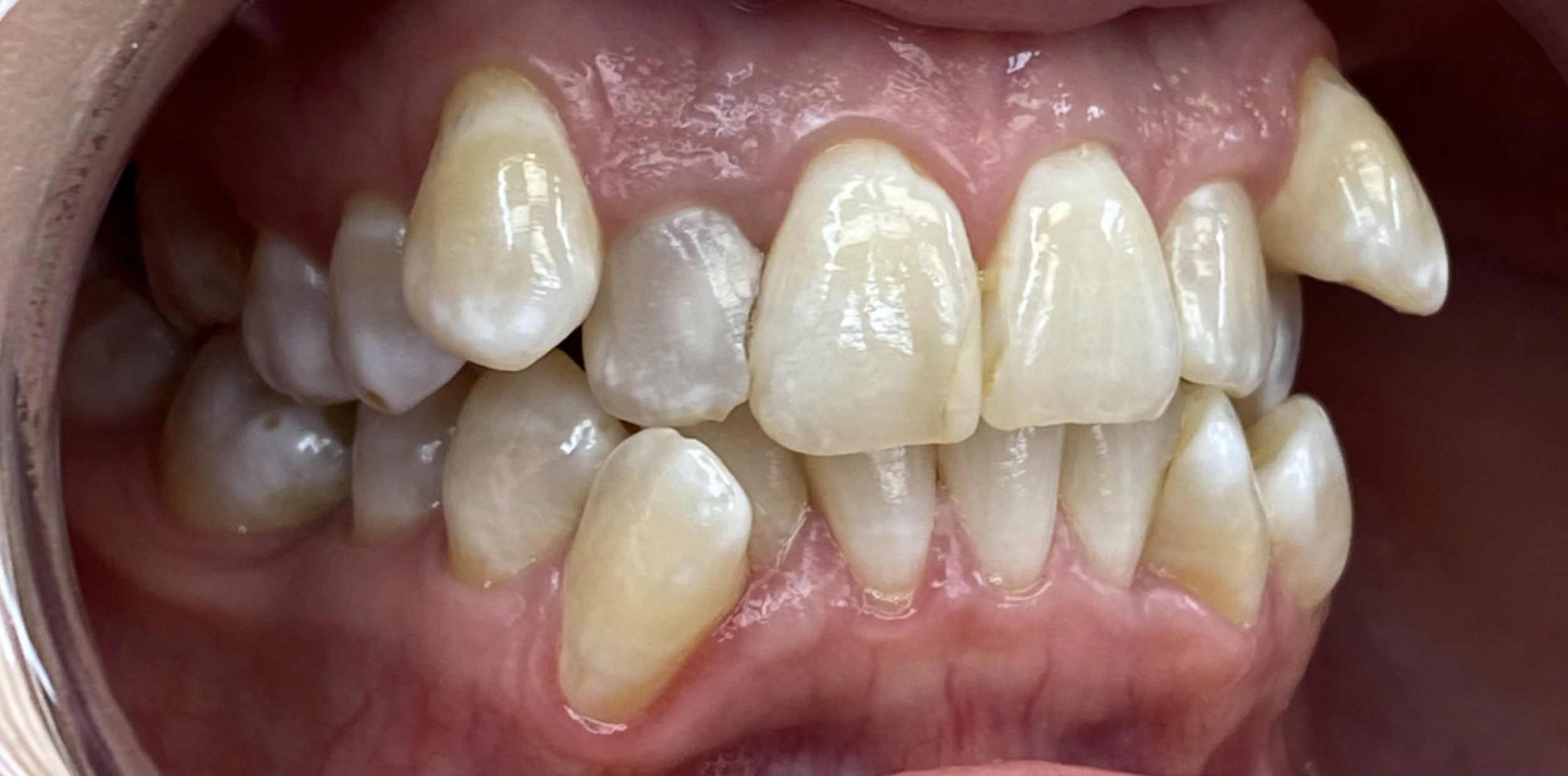 Close-up of a person's upper and lower teeth with visible plaque buildup and misalignment.