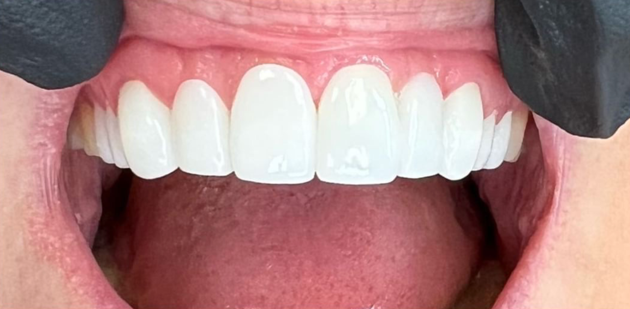 Close-up of a person showing their open mouth with white teeth and pink gums.
