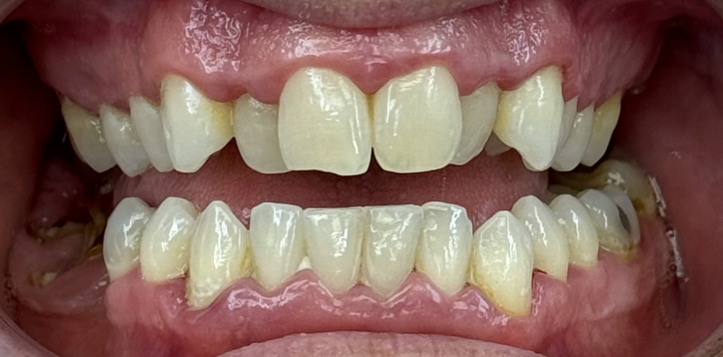 Close-up of a person's open mouth showing teeth with discoloration and plaque buildup.