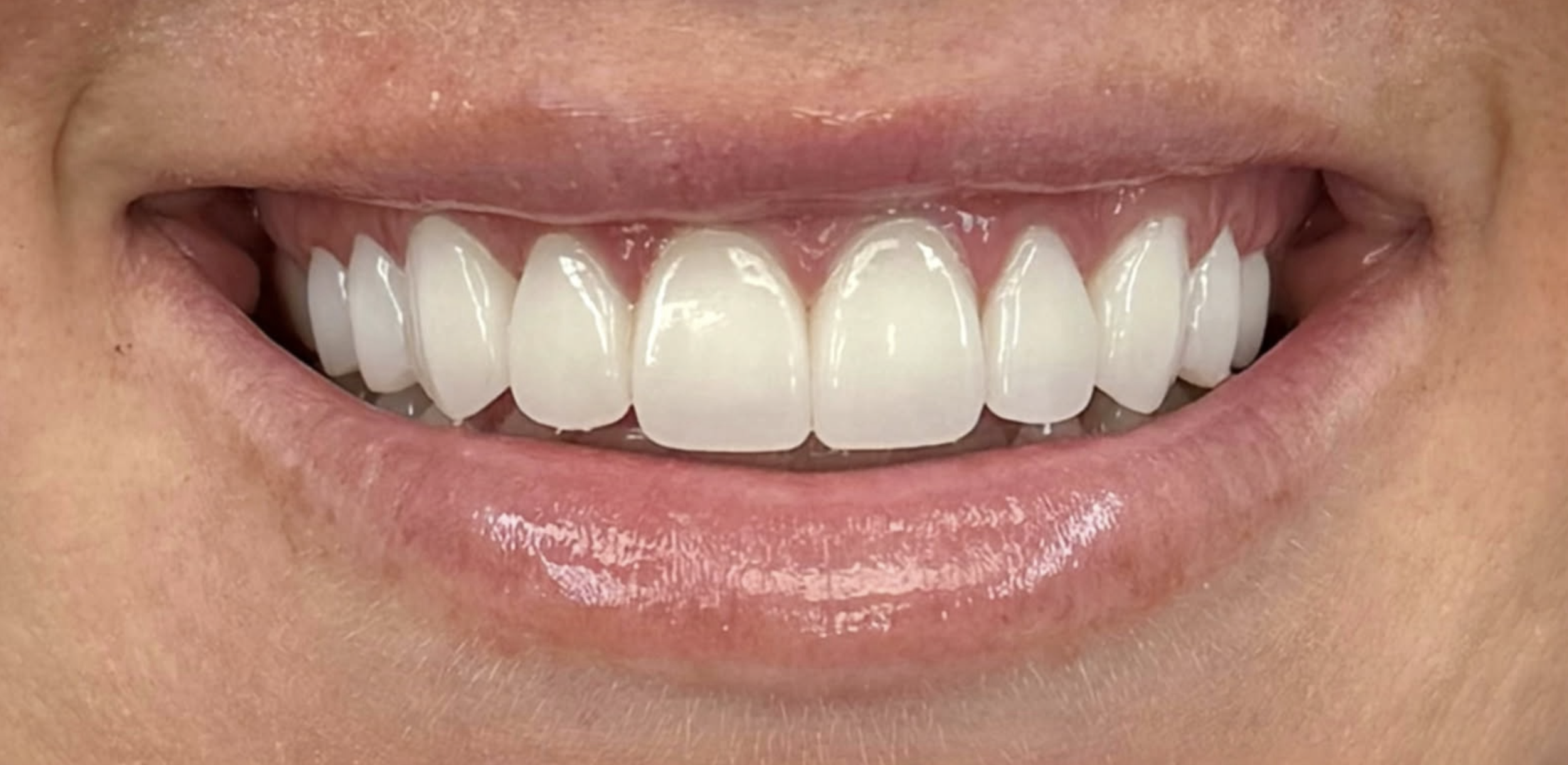 Close-up of a person's wide smile showing straight, white teeth with pink gums.