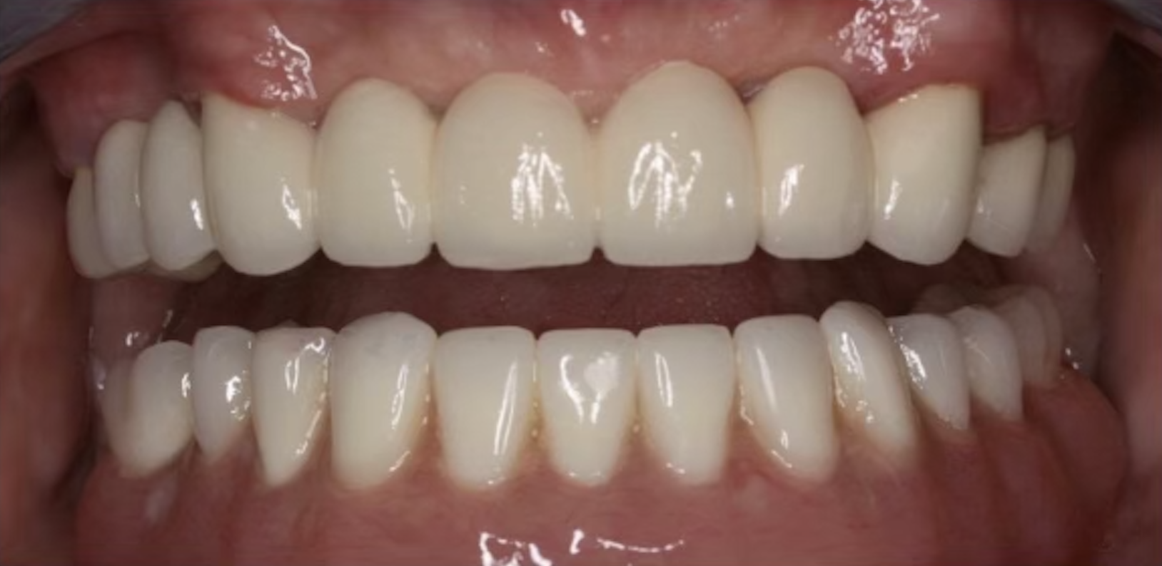 Close-up of a person's open mouth showing upper and lower teeth.