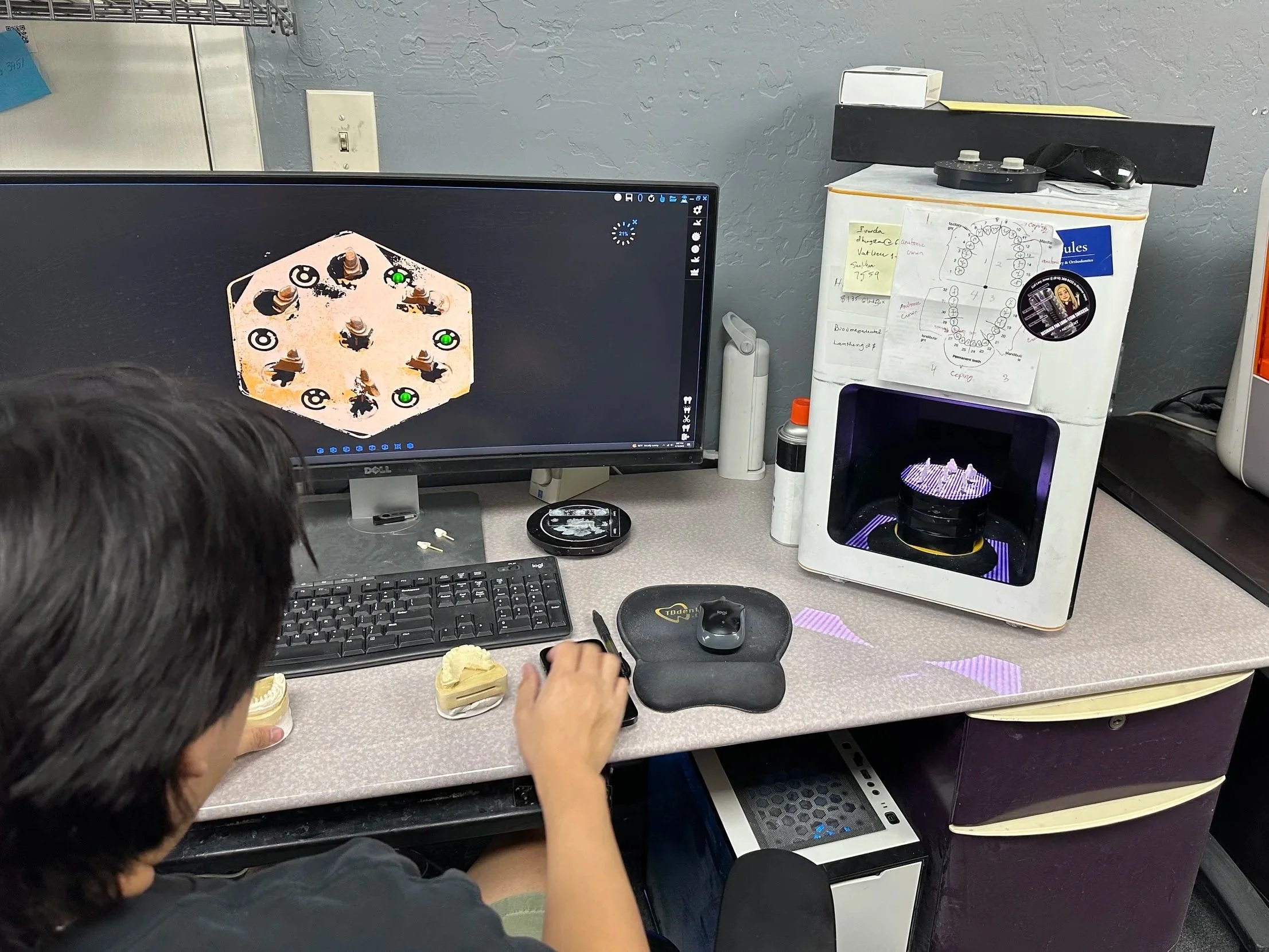 3D digital model of a set of human teeth and gums on a blue grid background.
