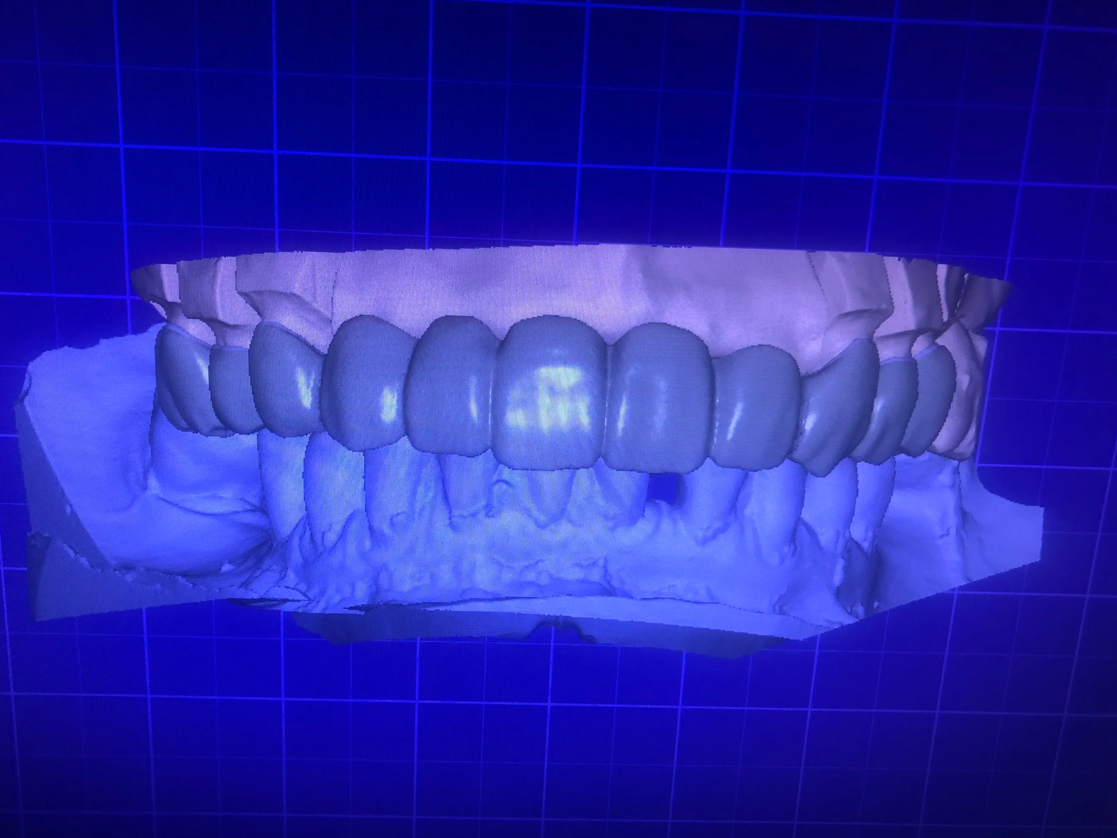 Dental molds and models of teeth on a gray surface.