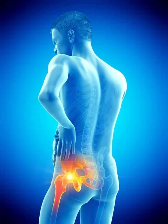 Sciatica 1.JPG