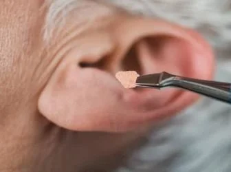 Ear Tacking