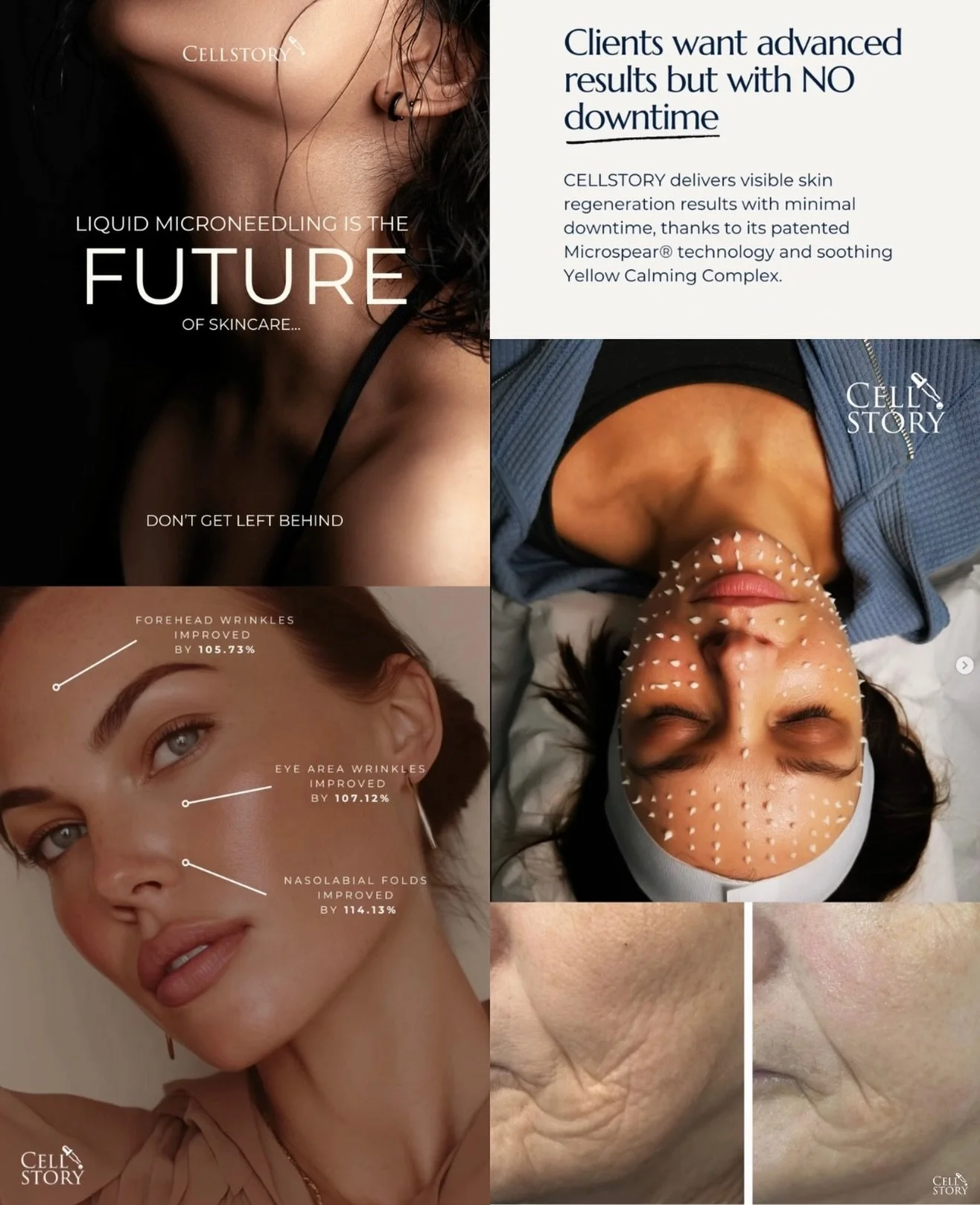 We are thrilled to announce CELL STORY Liquid Microneedling &mdash; the next generation of skin renewal. ✨

Unlike traditional microneedling, this innovative &ldquo;liquid microneedling&rdquo; treatment works without devices, using advanced micro-spi