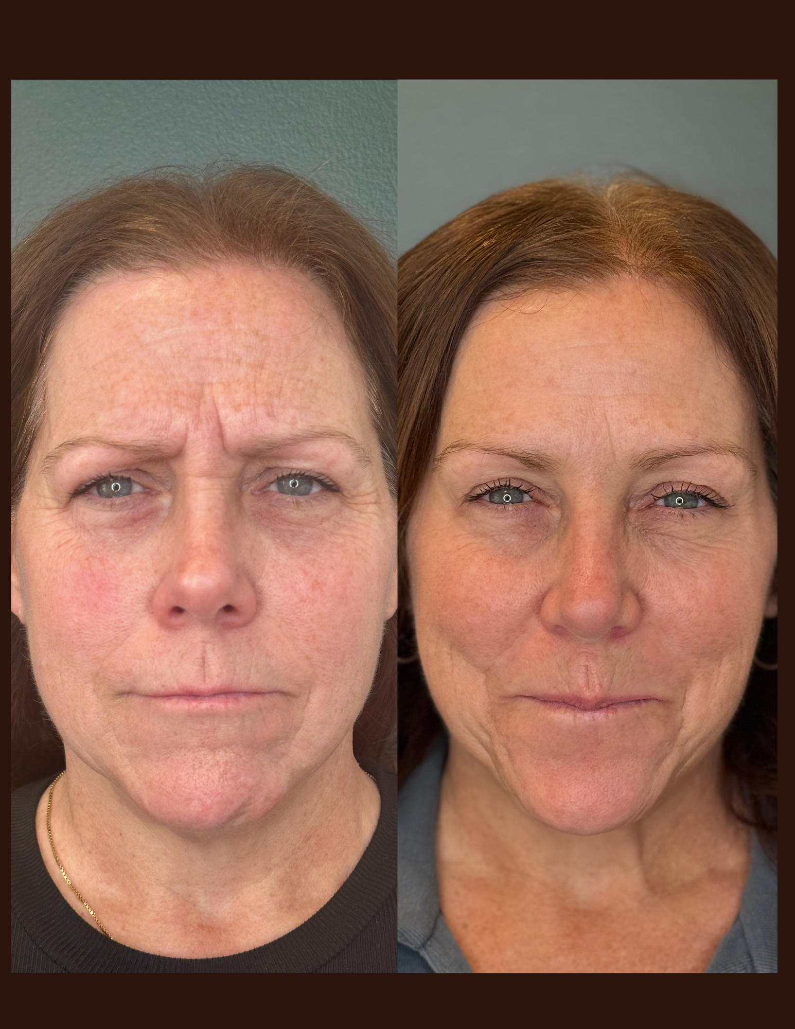 Botox Front View #2.png