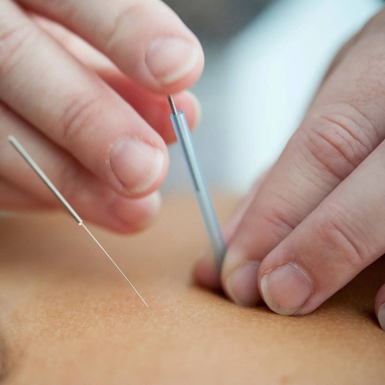 Experience the Benefits of Dry Needling at Bondi Podiatry: Relieve Pain and Enhance Healing