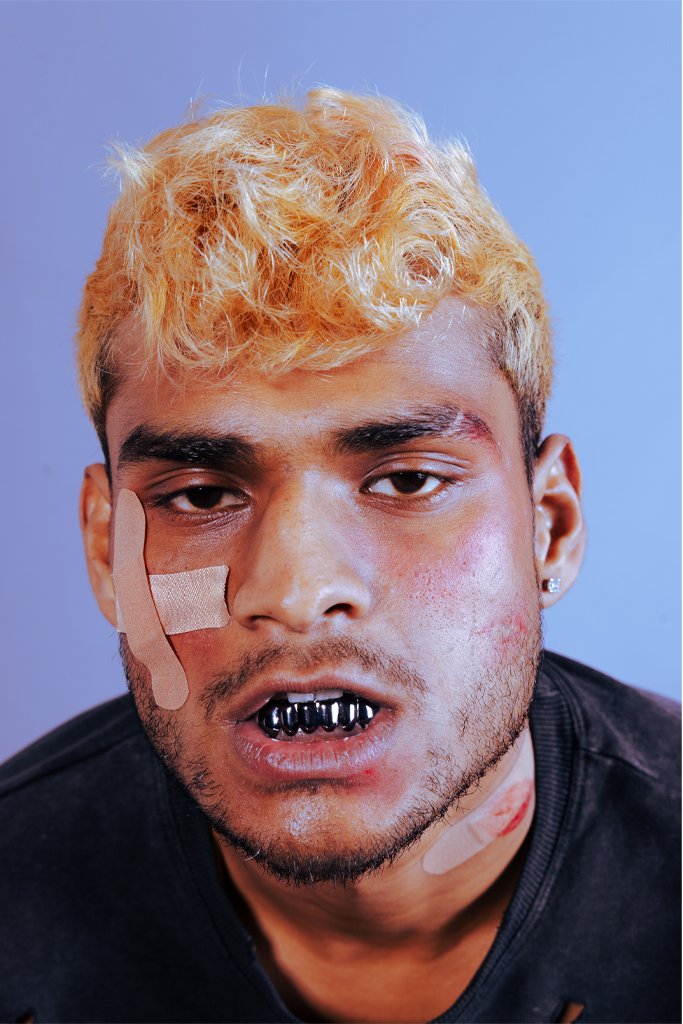 A young man with bleached blonde hair, wearing a black shirt, has a bandage on his cheek, missing teeth, and visible facial injuries. His expression appears tired or distressed.