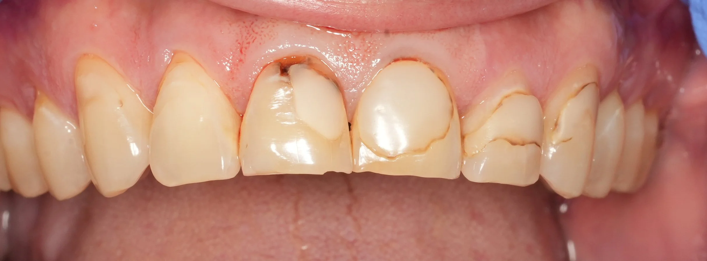 Close-up of damaged and decayed upper front teeth with visible cracks, discoloration, and decay.