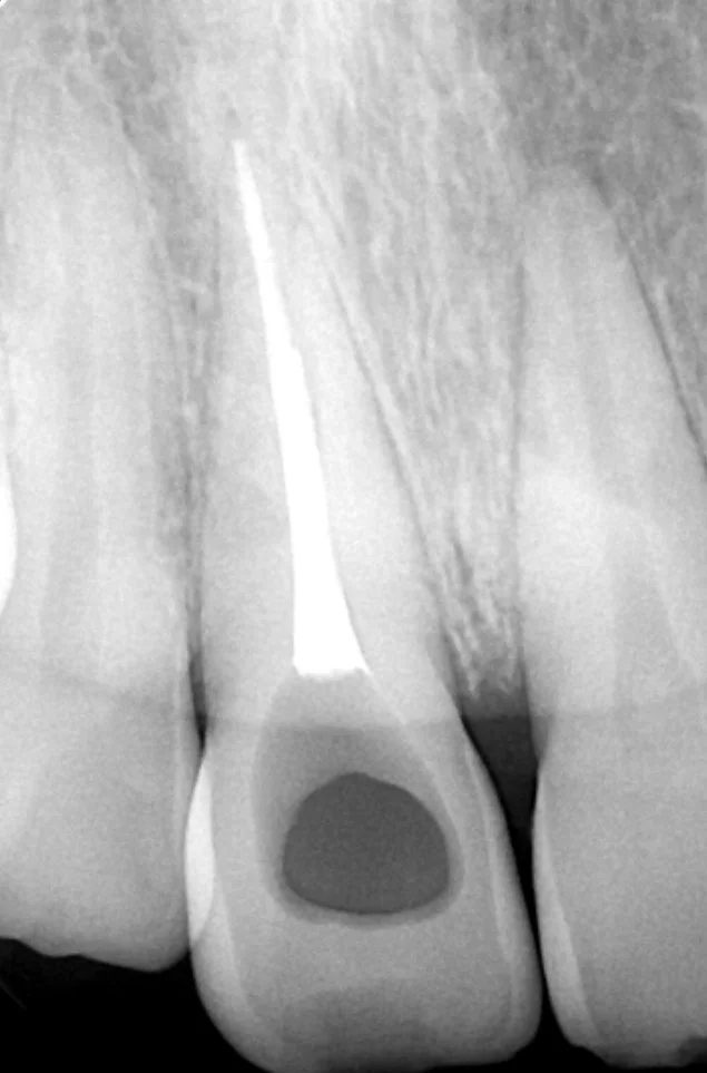 X-ray image of two front teeth with a root canal treatment in the tooth in the middle.