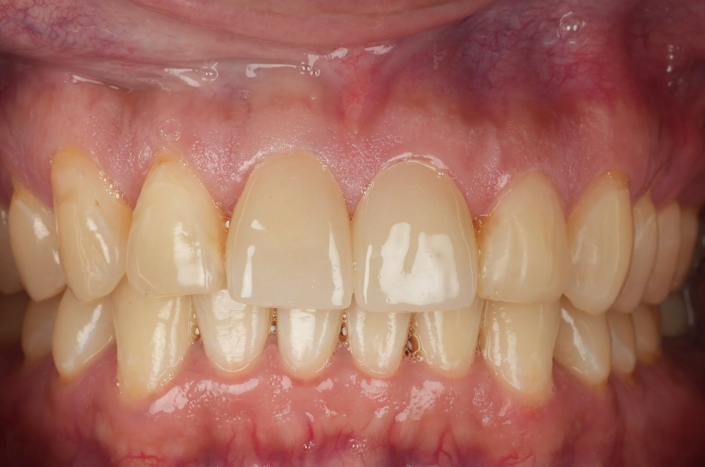 Close-up of upper front teeth restored with ceramic crowns and composite fillings.
