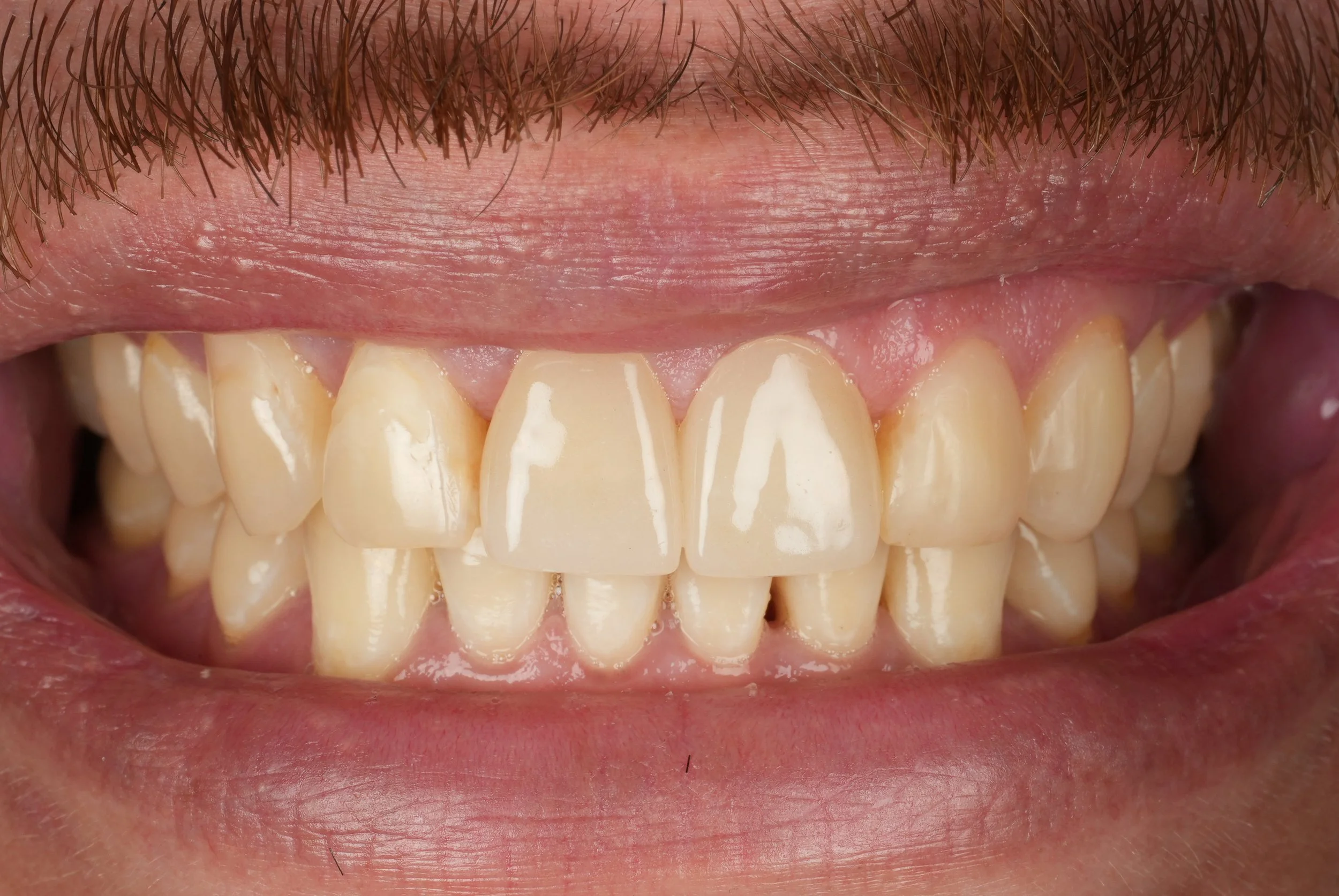 Close-up of upper front teeth restored with ceramic crowns and composite fillings.