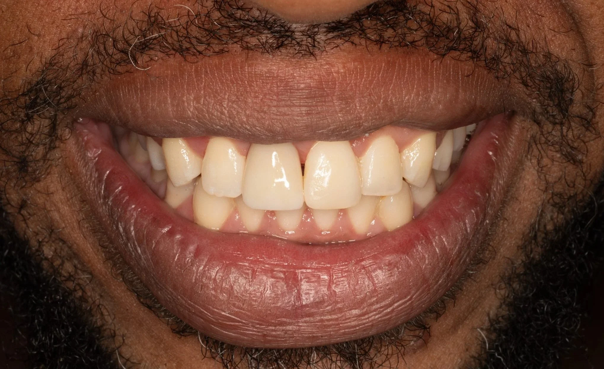 Close-up of a smiling person with dark skin, showing their teeth and a full mustache and beard.