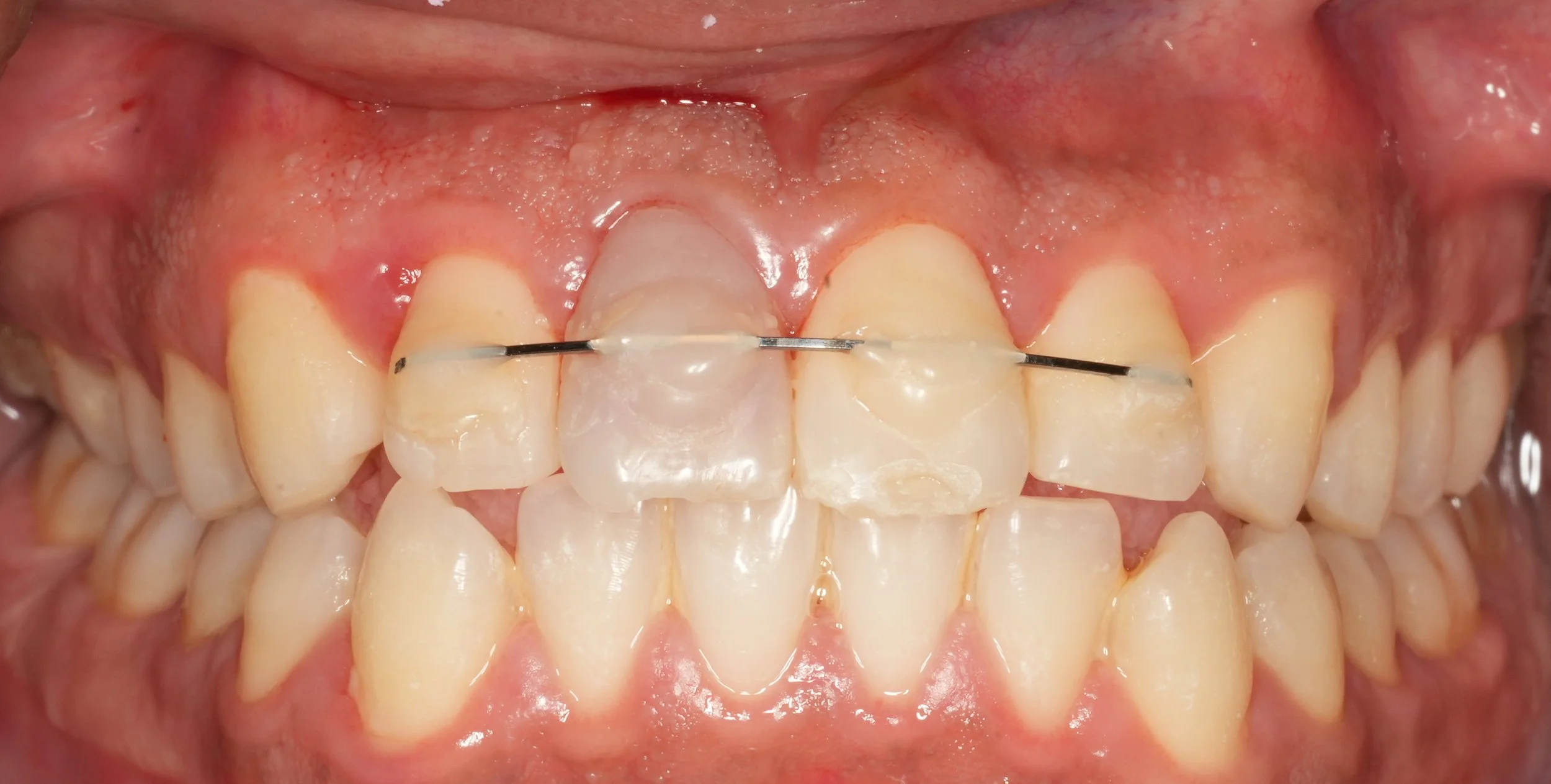 Close-up of a person's upper teeth with a dead and necrotic tooth needing restoration.