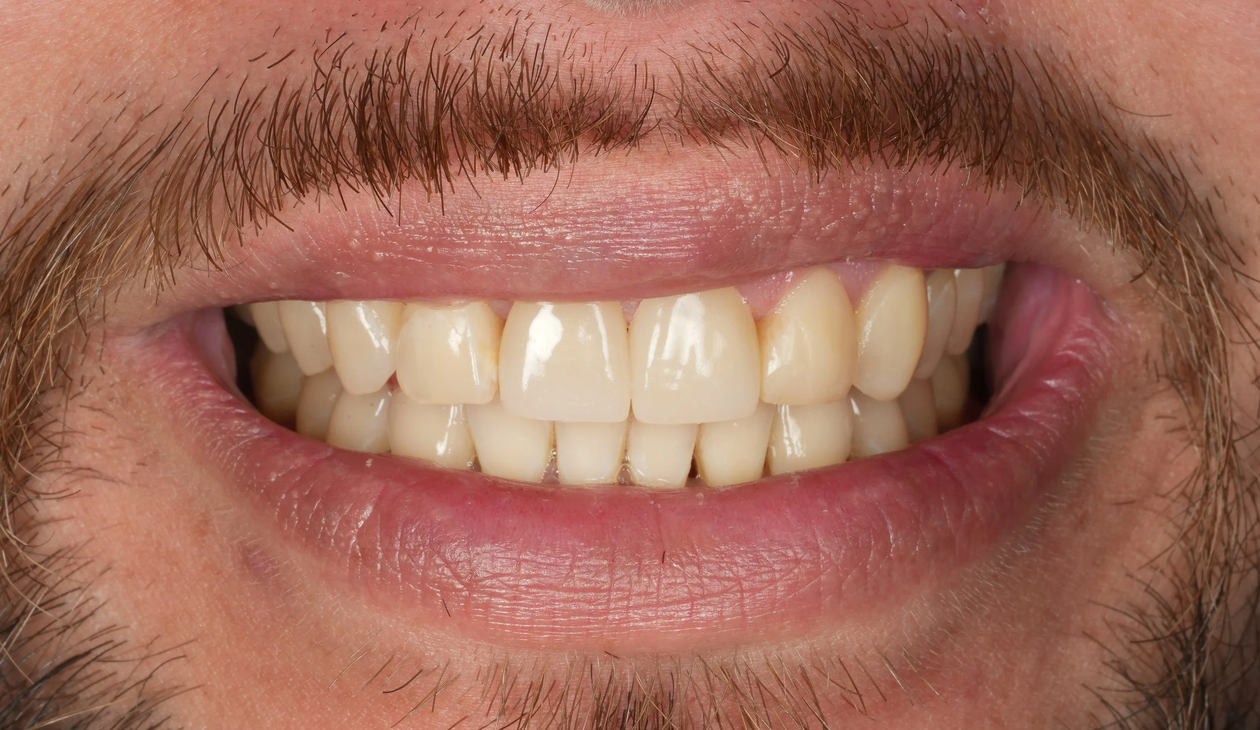 Close-up of upper front teeth restored with ceramic crowns and composite fillings.