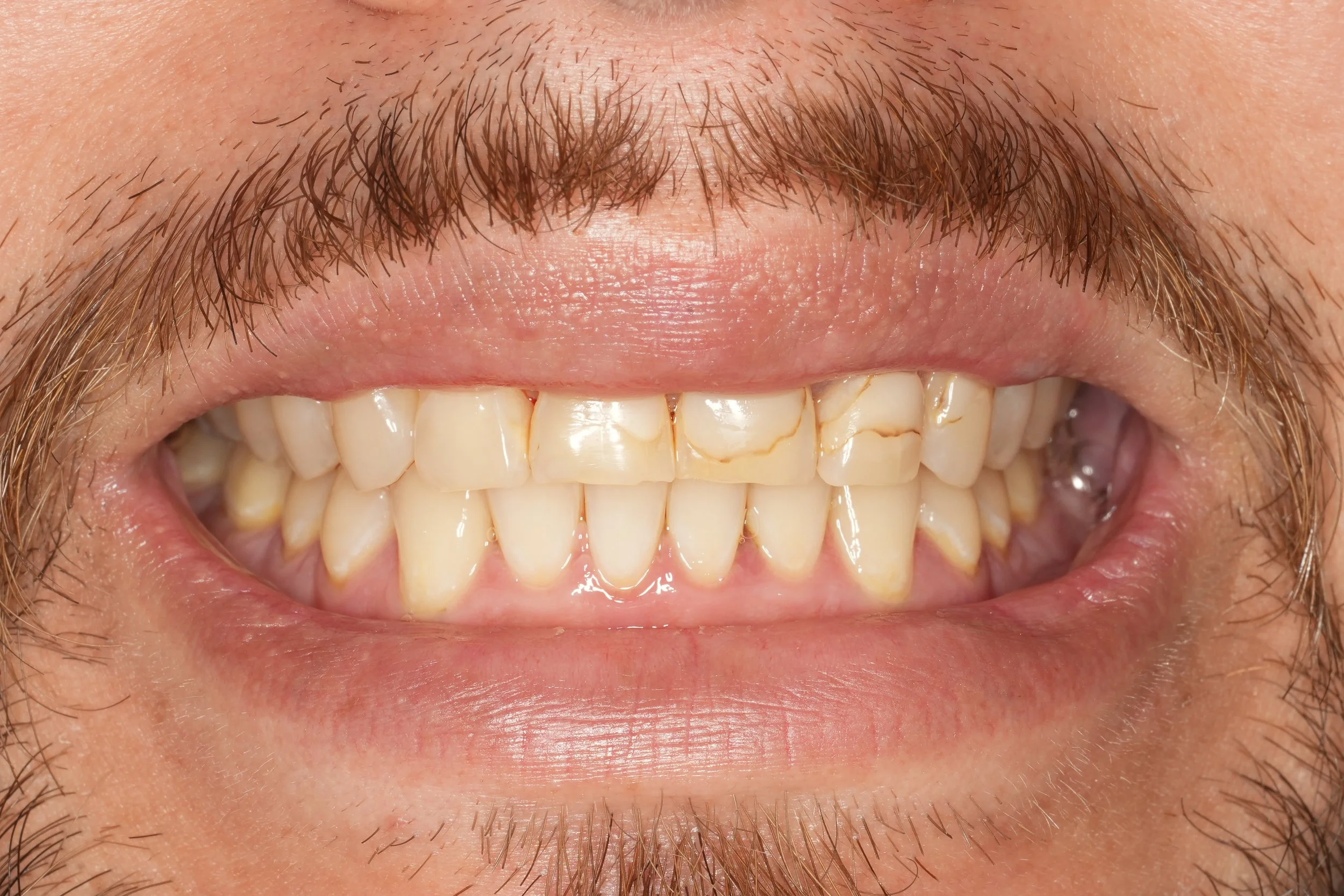 Close-up of a smiling person's mouth showing teeth with decay and discoloration.