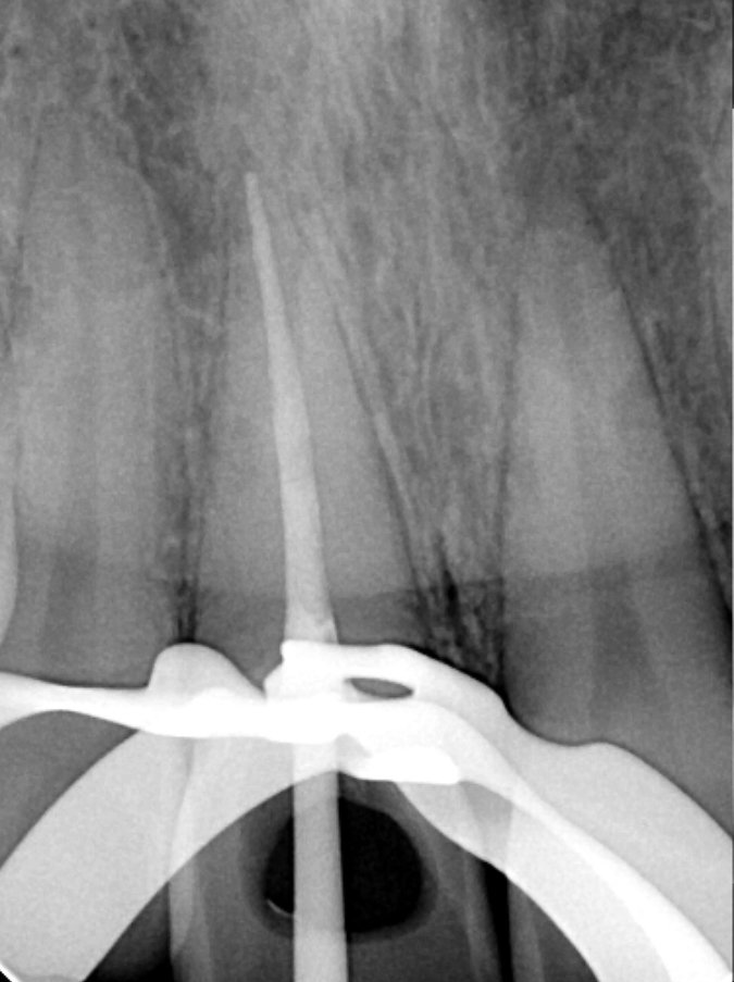 Dental X-ray showing root canal treatment.