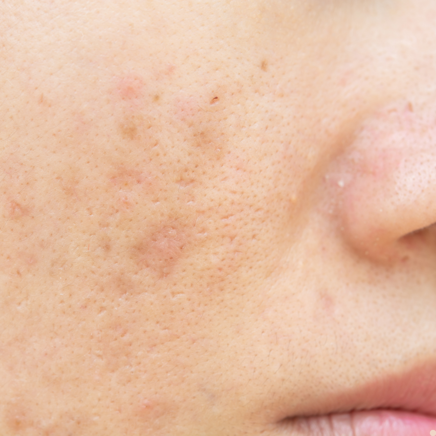 Hyperpigmentation, Sun Spots &amp; Dark Spots: What They Are + How I Treat Them