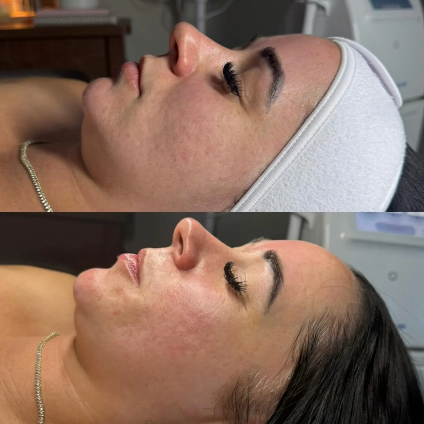 If your skin has been looking a little dull, textured, or tired, this combo is your new obsession.

The Hydro Facial is completely customizable to your skin concerns&mdash;whether you&rsquo;re dealing with clogged pores, dryness, fine lines, acne, or