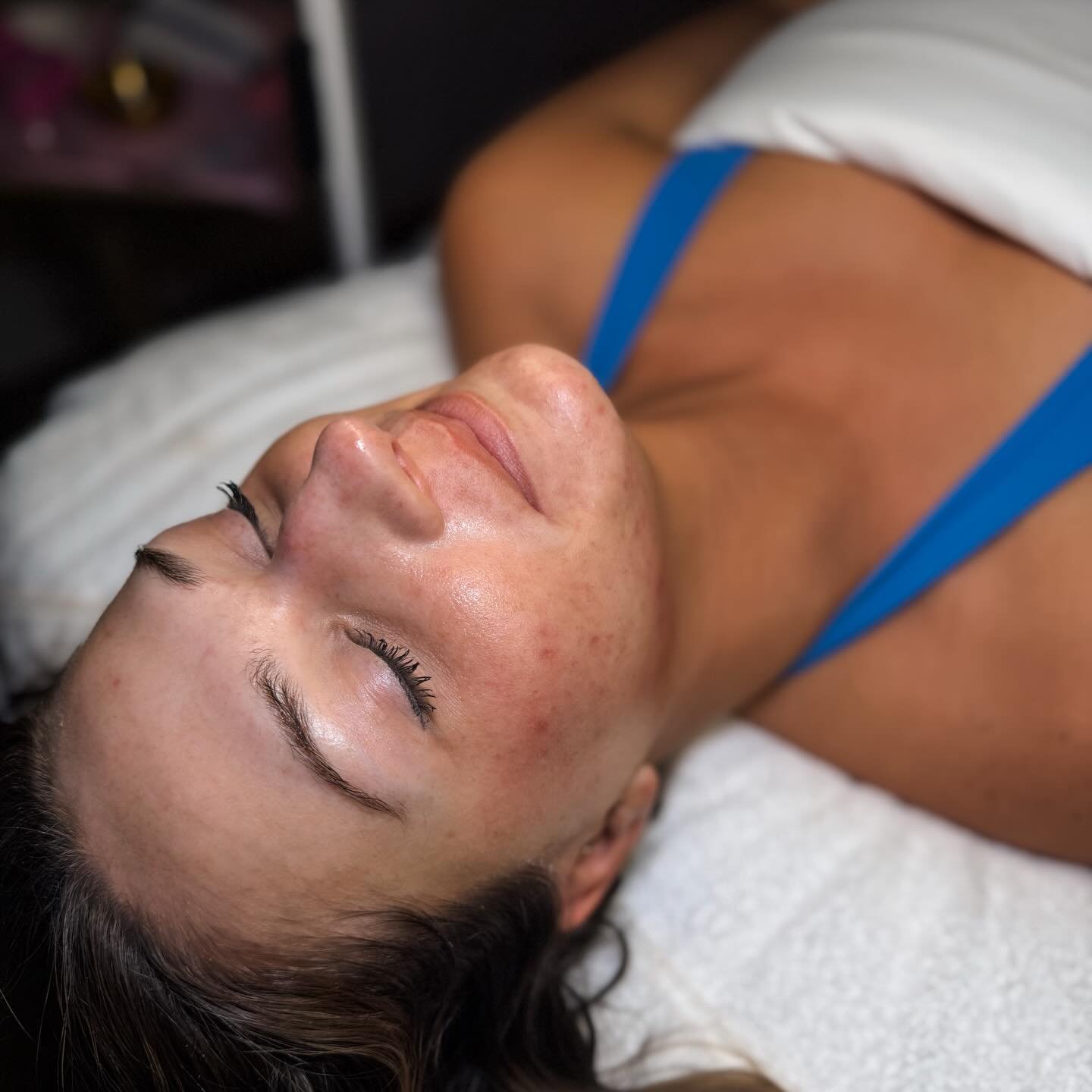Post Facial Glow ✨ Time to start taking care of your skin! We have been working together on her skin for about 8 months- the progress is insane! We have calmed imflammed acne and now rebuilding collagen &amp; fading scaring!