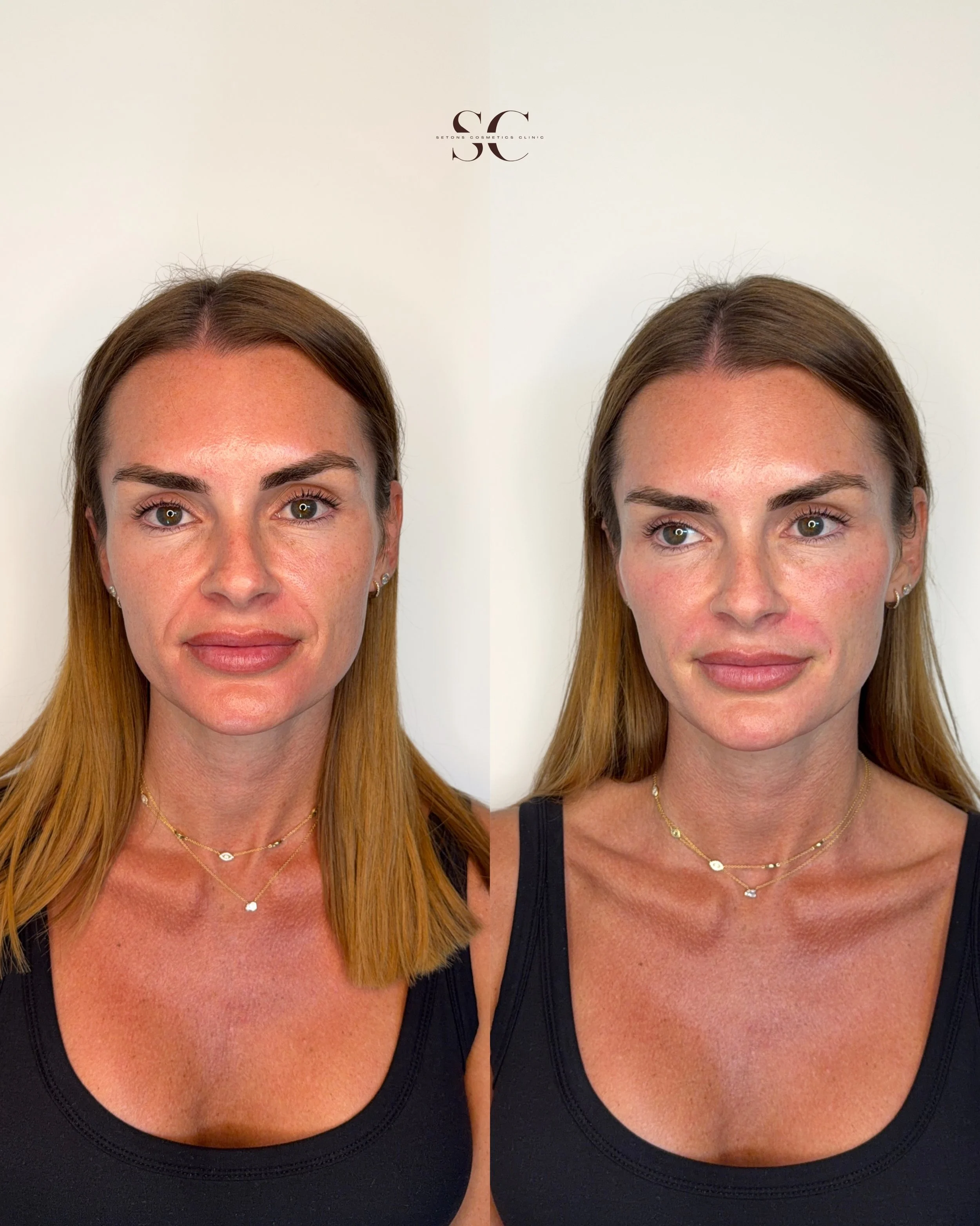 Nurse Luke: NMW0002227767

DISCLAIMER: Setons Cosmetics Clinic offers a range of cosmetic and dermatological treatments designed to improve skin health, address signs of ageing, and enhance overall facial balance. A comprehensive consultation is requ