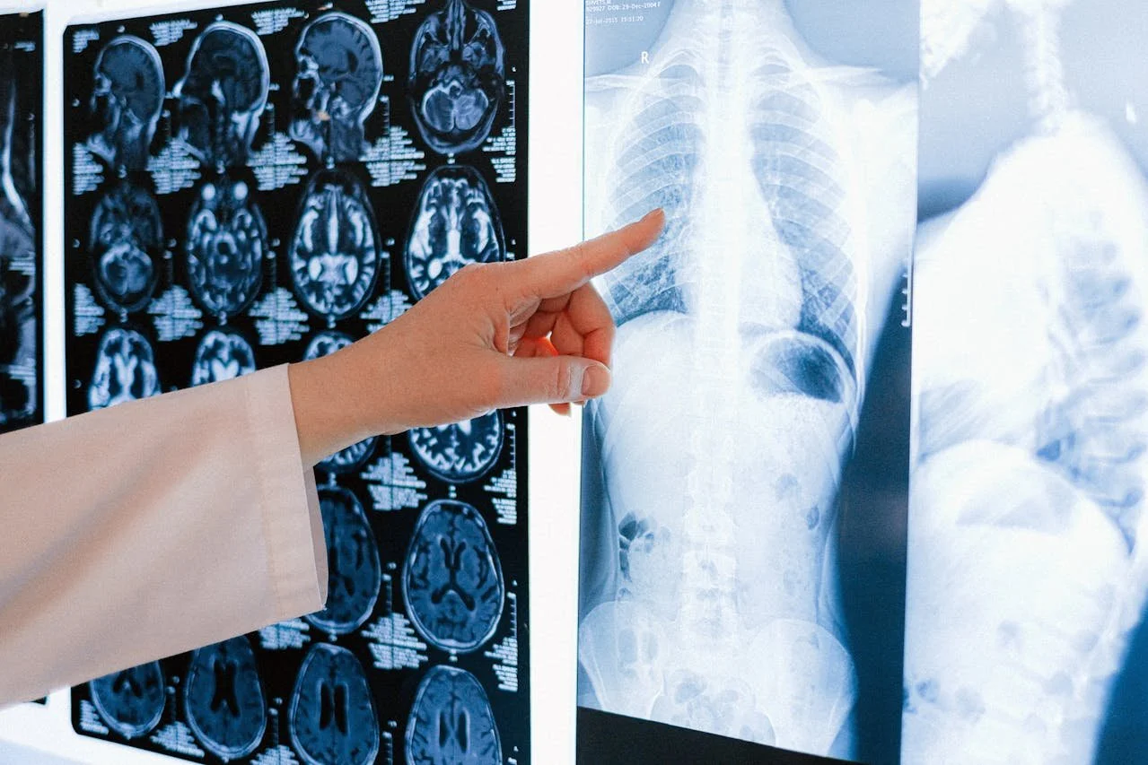 The value of increased diagnosis of osteoporosis