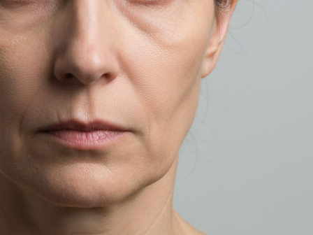 Facial Volume Loss