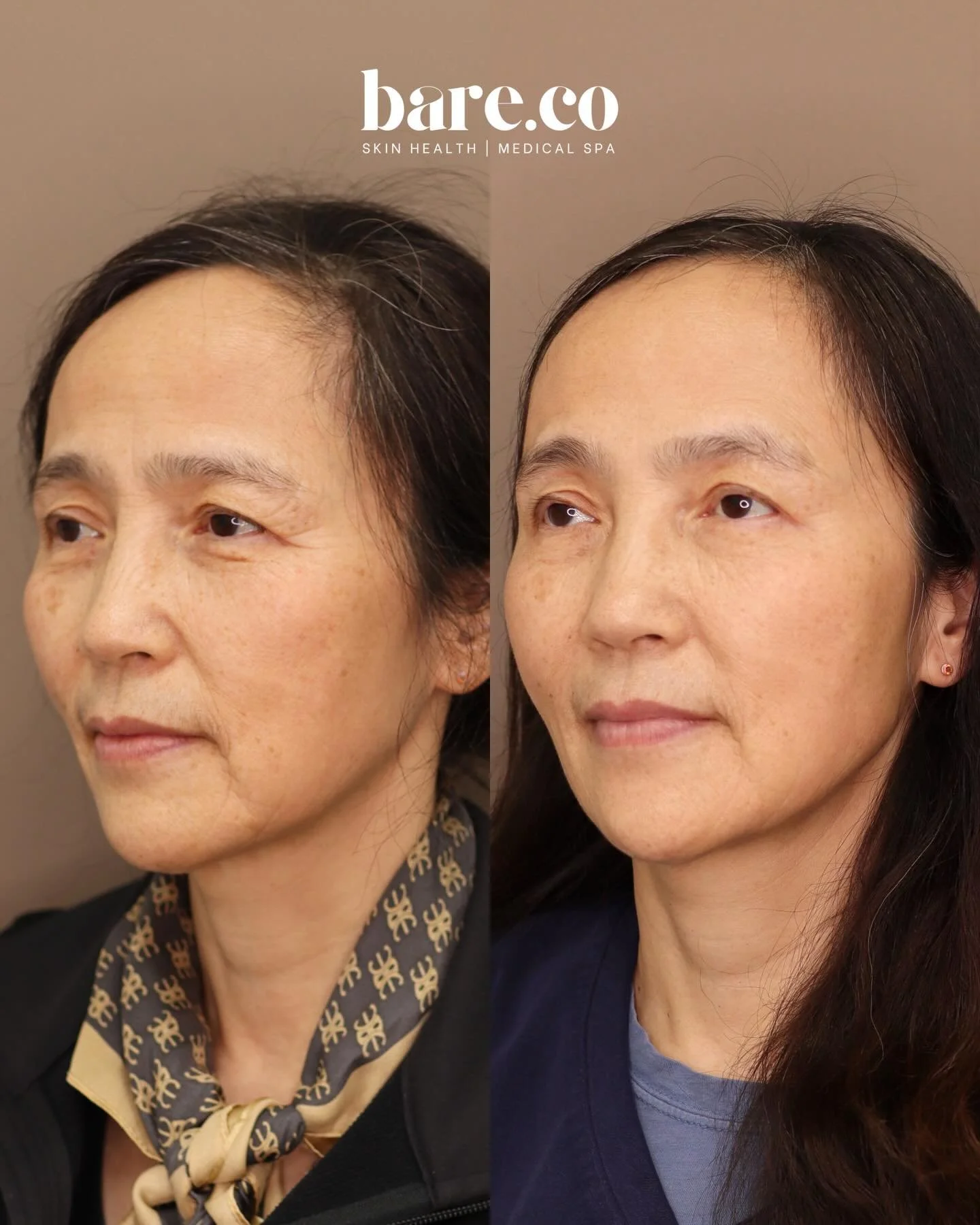As we age, changes in skin quality, elasticity, and fine lines are completely normal &mdash; but that doesn&rsquo;t mean we can&rsquo;t age beautifully and intentionally ✨

For this patient, the goal wasn&rsquo;t to &ldquo;erase&rdquo; every line (be