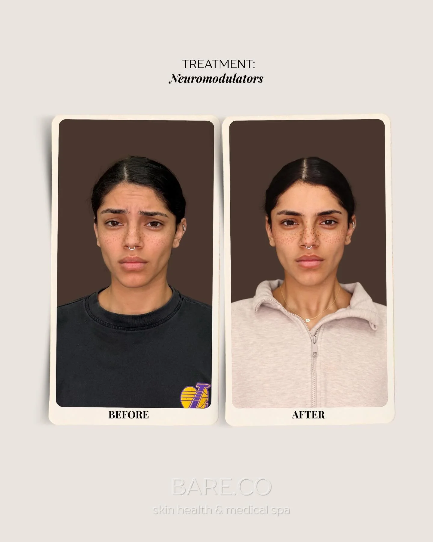 Strategic upper face tox placement makes all the difference ✨

💉 by: @christylynn.np
📍 Fountain Valley, CA
📱 Text: 714-276-8998
🔗 Booking link in bio

#barecoskin #wrinkletreatment #naturalbotox