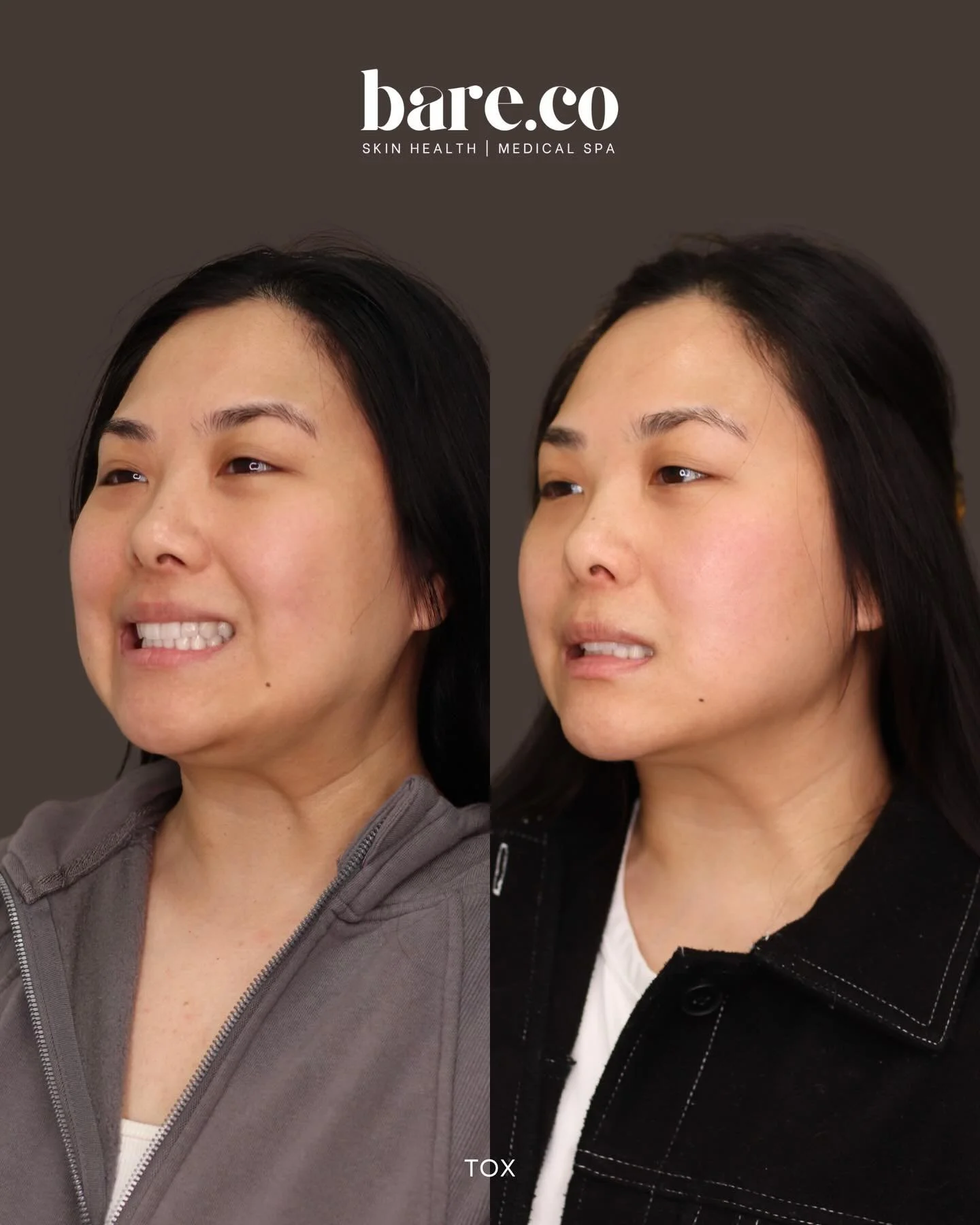 SNATCHING the jawline with strategic tox placement ✨

One of our favorite treatments for subtle lift and contour along the jawline and lower face works by relaxing muscles that pull the face downward &mdash; especially around the mouth and neck.

Whe