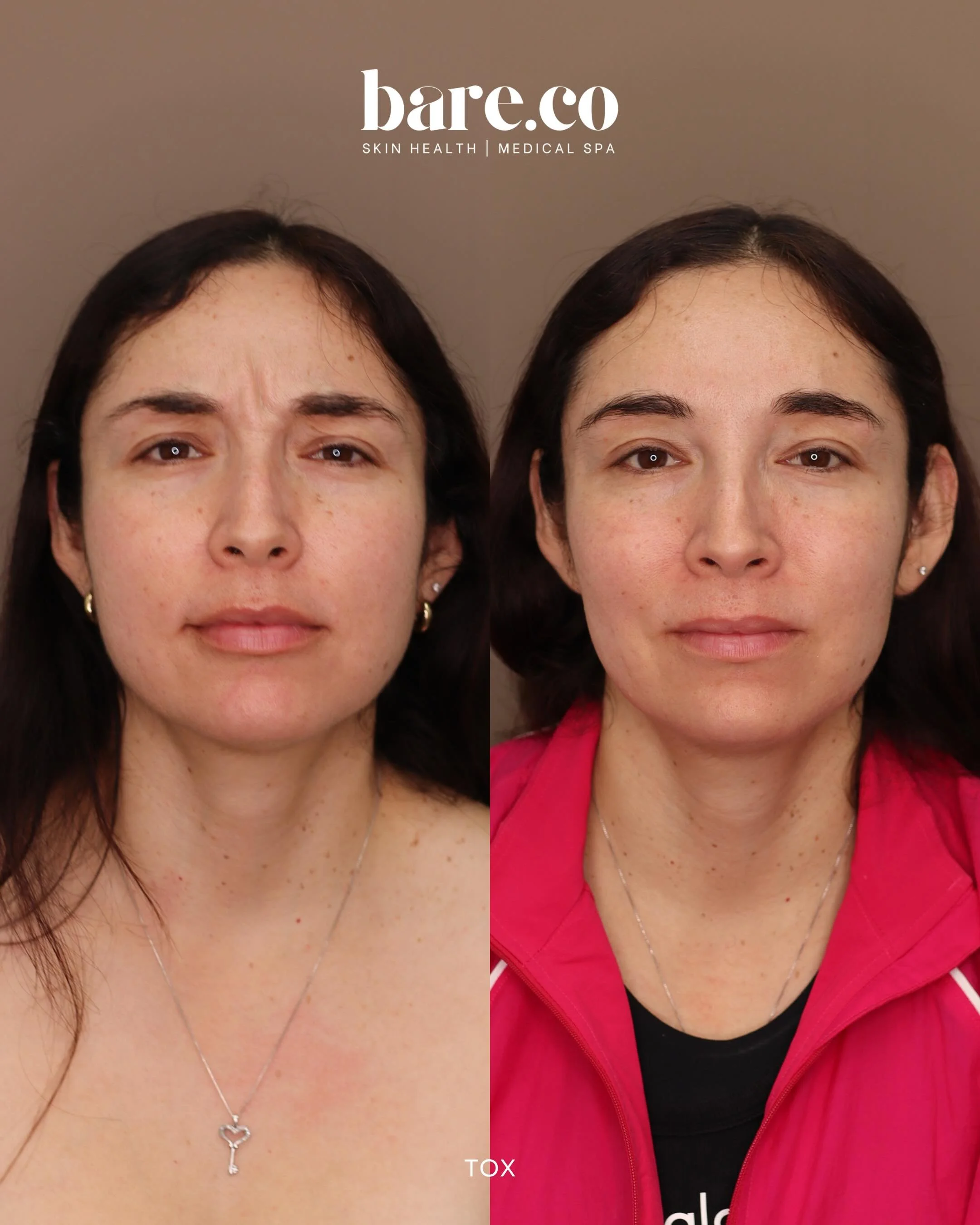 Softened, not frozen ✨

A little tox to smooth movement &amp; soften expression lines!

Enter your era of bare confidence:
📍 Fountain Valley, CA
📱 Text 714-276-8998
🔗 Booking link in bio

#barecoskin #wrinkletreatment #crowsfeet #beautytransformat