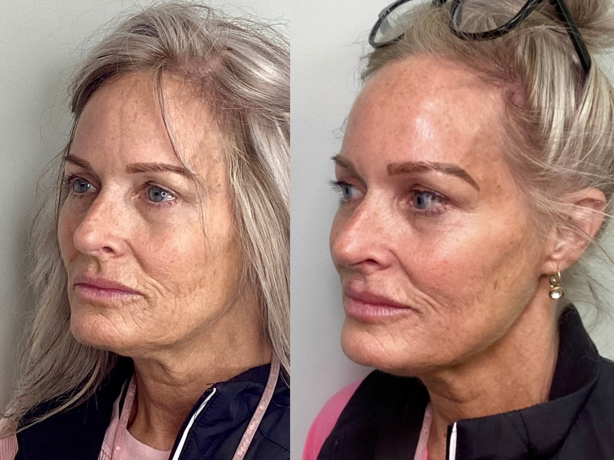 Lip Filler 