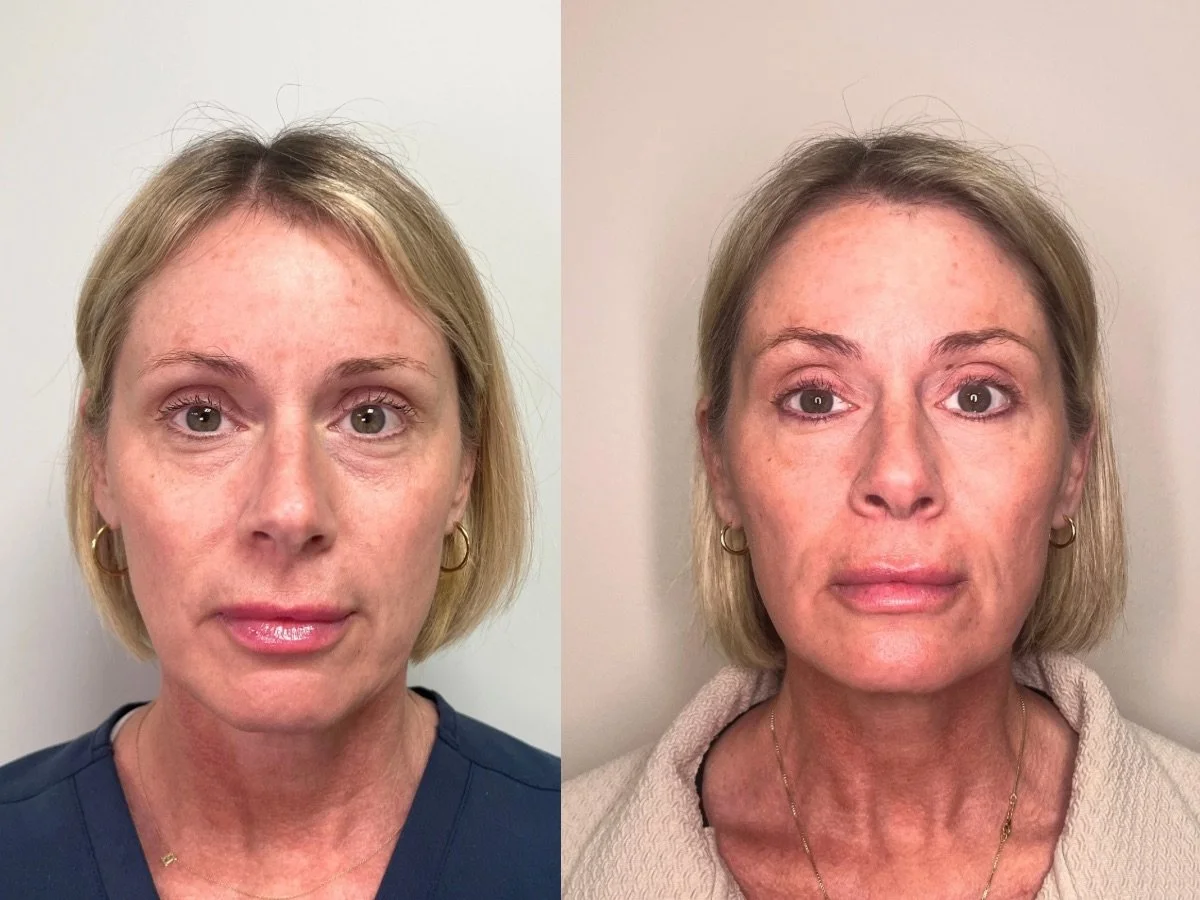 Emface Non Surgical Facelift, the skin clinic, Mankato
