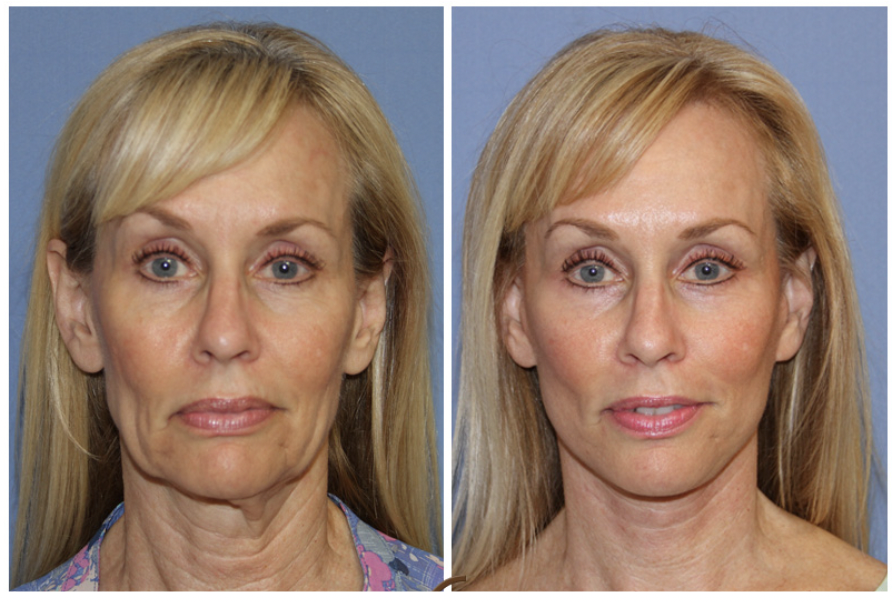 Side-by-side images of a middle-aged woman before and after cosmetic treatment, showing facial rejuvenation.