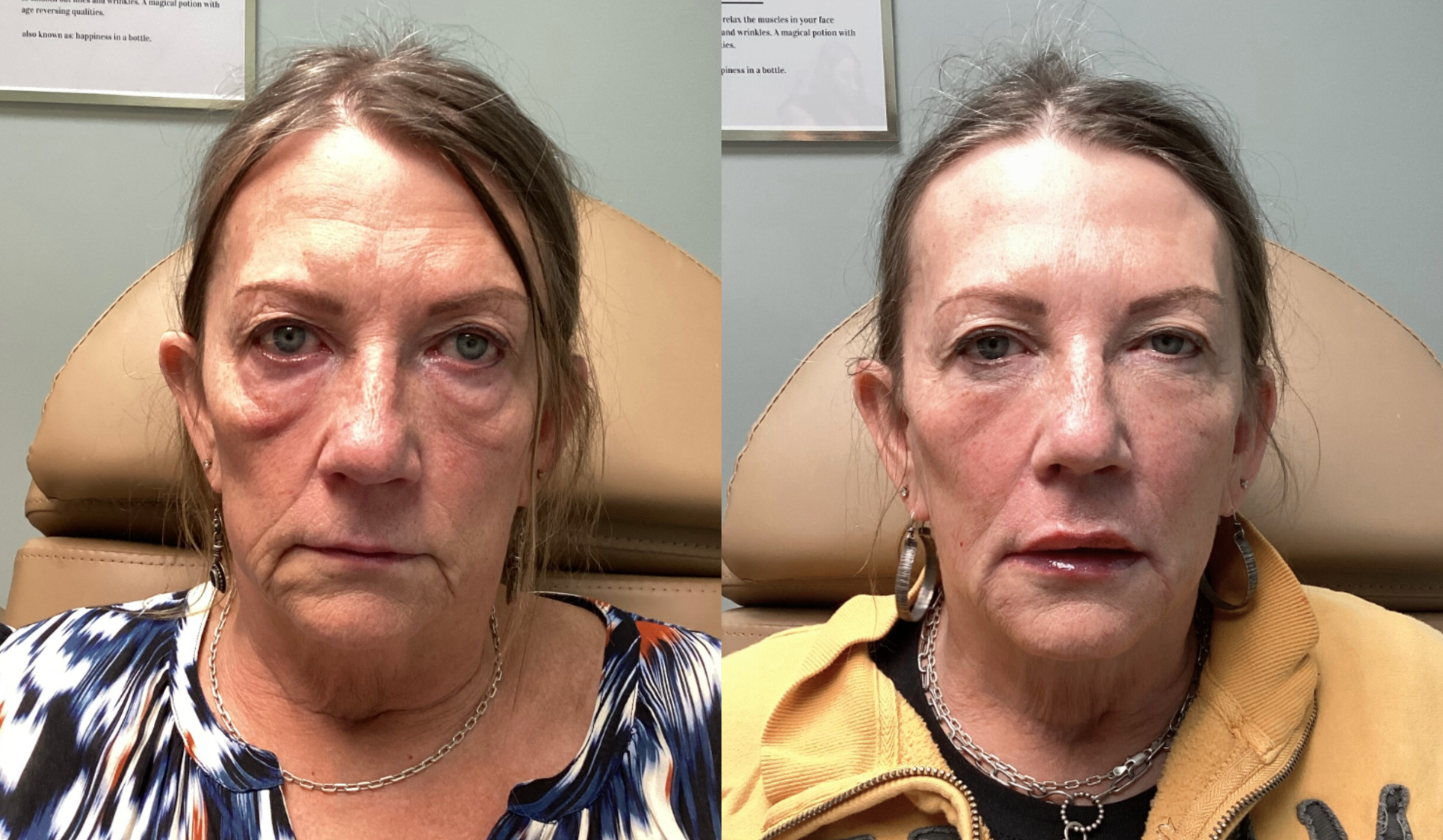 Side-by-side comparison of a woman before and after cosmetic treatment in a medical examination room, seated in a beige medical chair.
