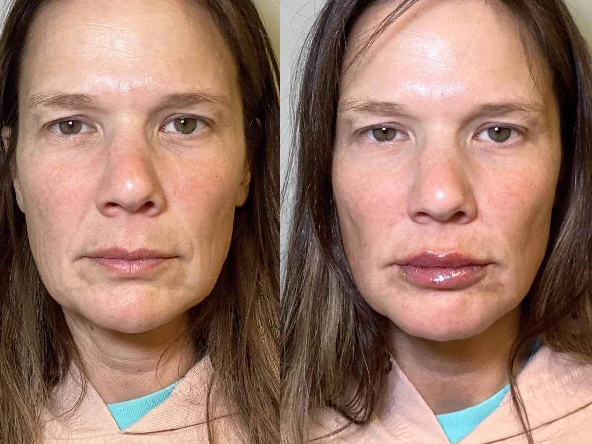 Lip Filler, Mankato, MN