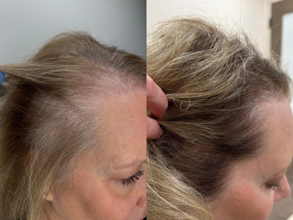 Comparison of a woman's scalp before and after hair treatment, showing improved hair density and coverage.