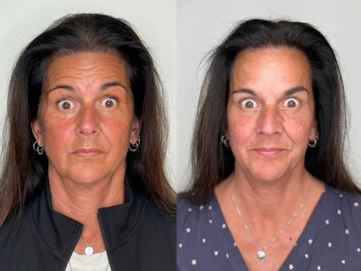 Botox Mankato, M