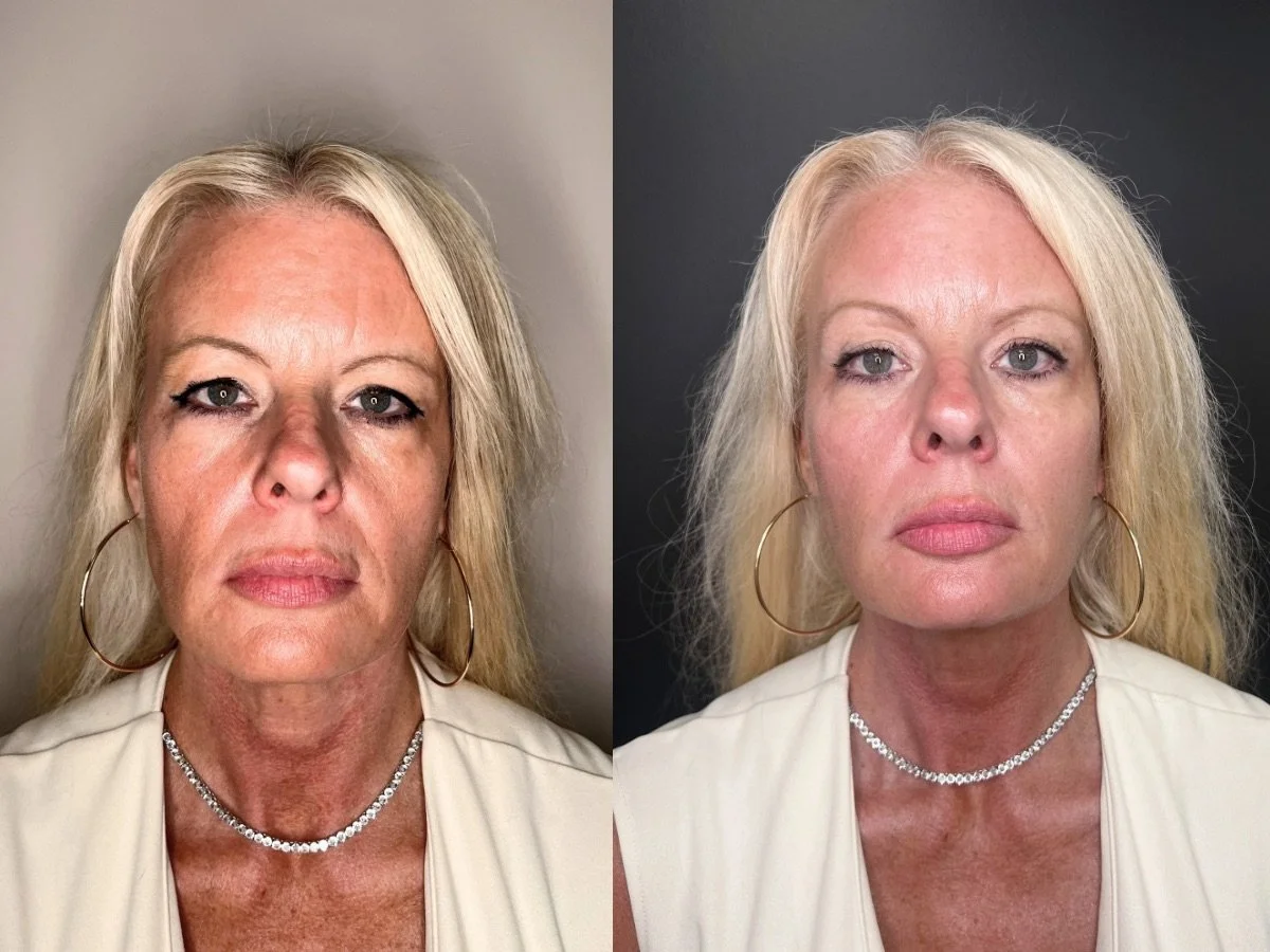 Dermal Filler Mankato, MN The Skin Clinic 