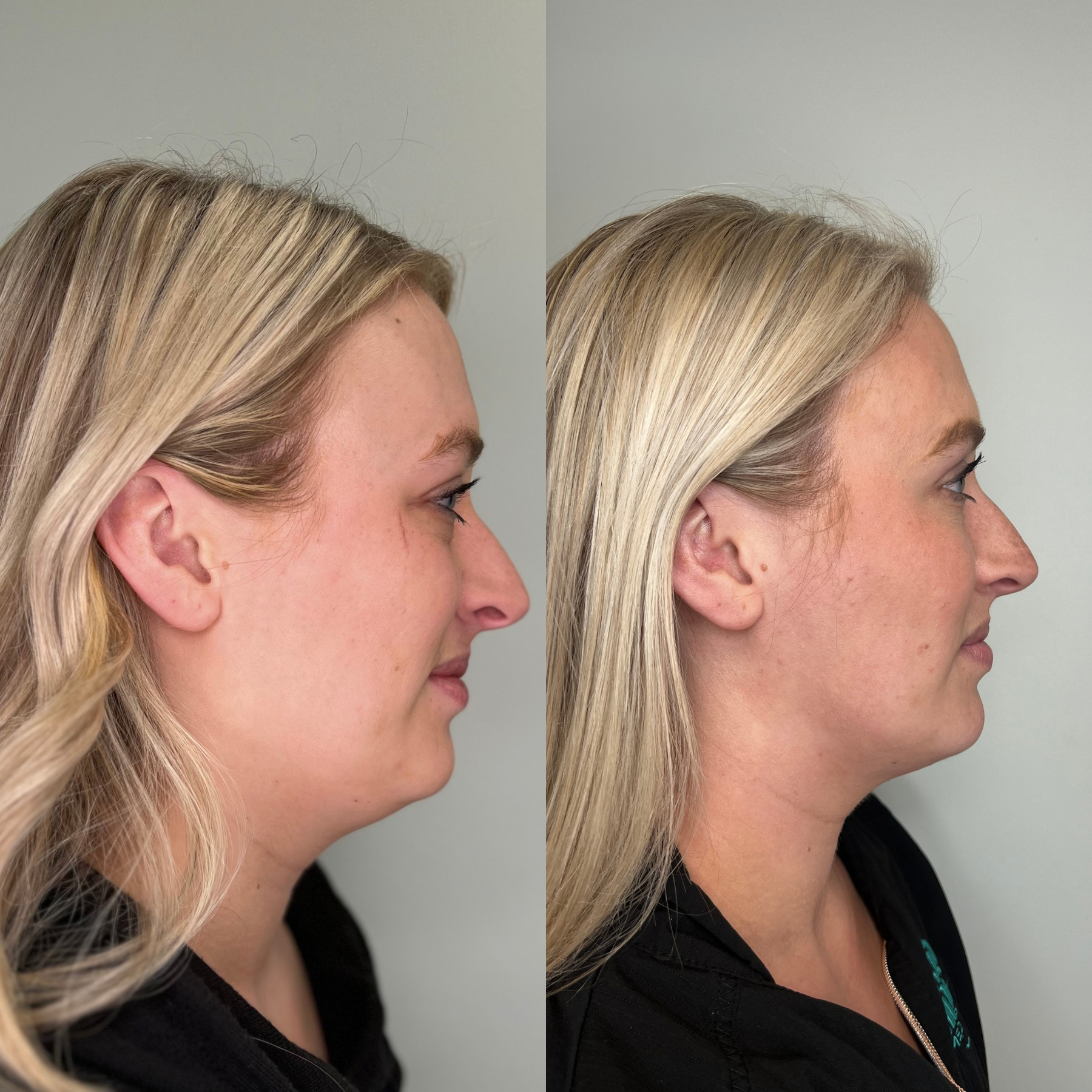 Side-by-side comparison of a woman's profile showing the before and after results of a cosmetic procedure on her nose and facial features, with blonde hair and a black top.