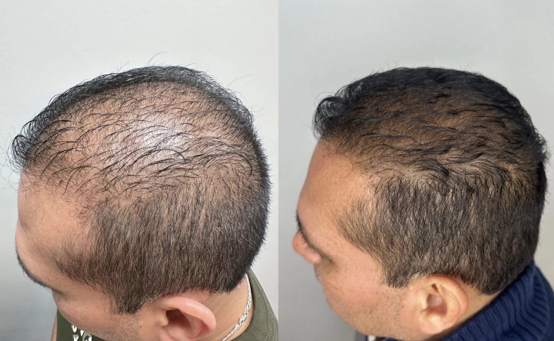 Comparison of a man's scalp before and after hair restoration treatment, showing increased hair density and scalp coverage in the after image.