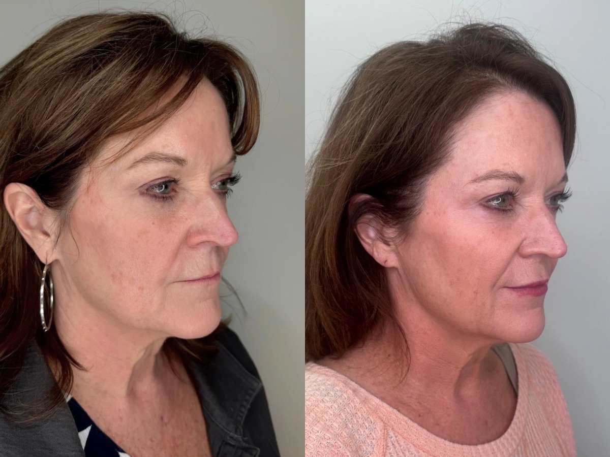 Emface Non Surgical Facelift, the skin clinic, Mankato