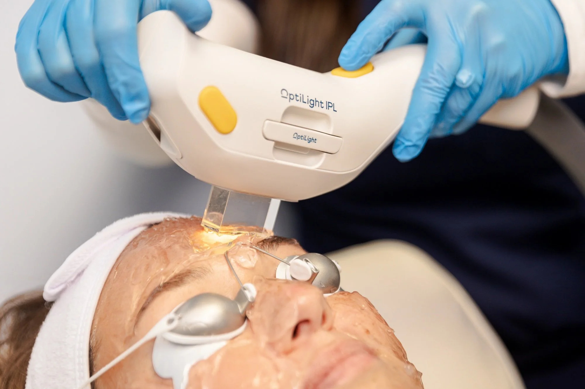 Top 3 Causes of Hyperpigmentation | How an IPL Photofacial Can Help