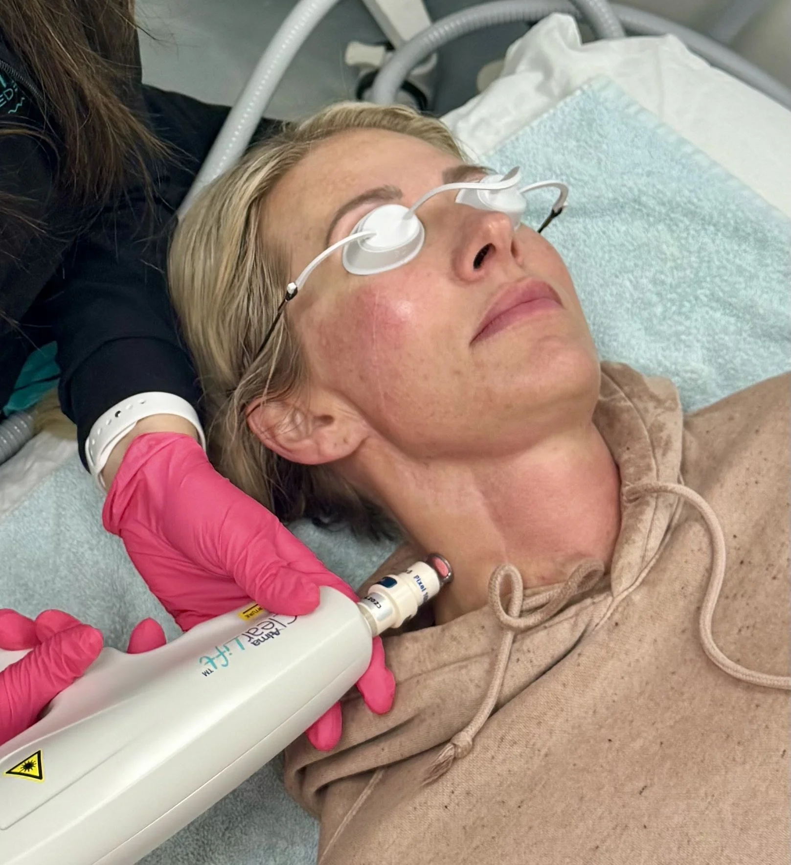 From Sun Damage to Smooth Skin: IPL Therapy Explained